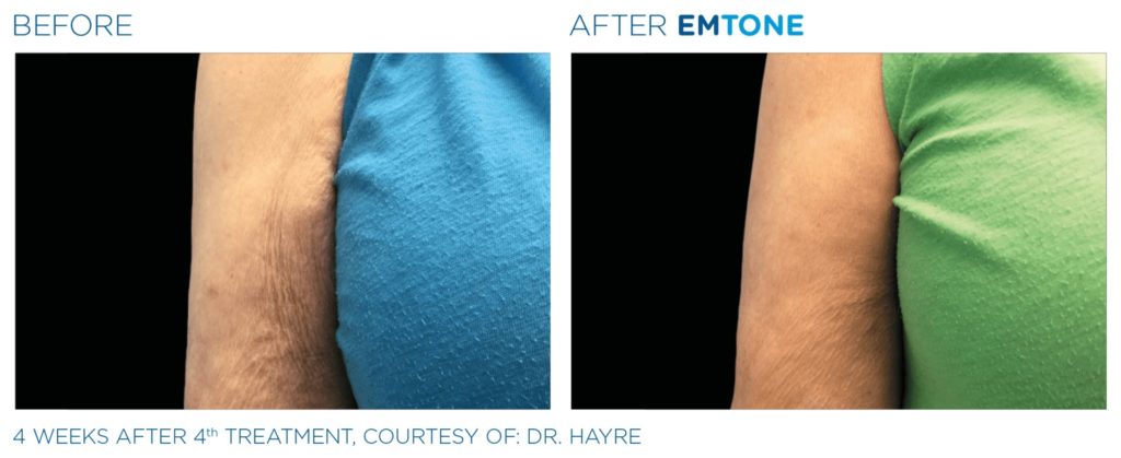 Emtone amélioration de la texture de la peau
