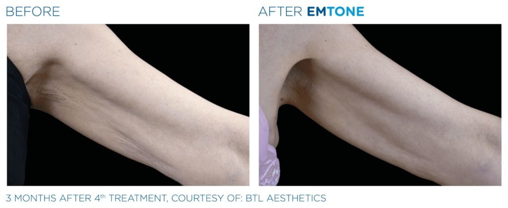 Emtone amélioration de la texture de la peau
