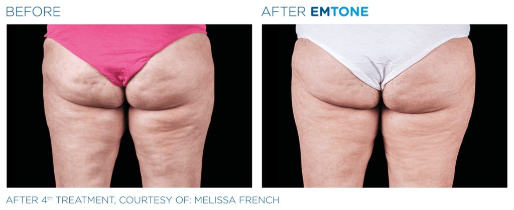 Une réduction significative des amas graisseux à l’origine de la cellulite