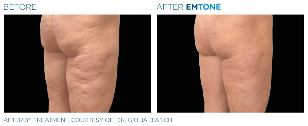 Réduction significative des amas graisseux à l’origine de la cellulite