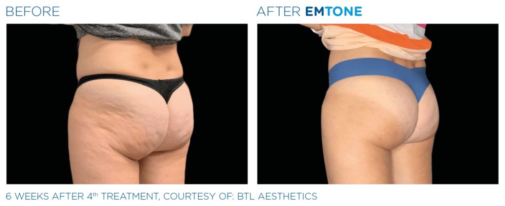 Réduction significative des amas graisseux à l’origine de la cellulite