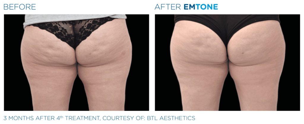 Réduction significative des amas graisseux à l’origine de la cellulite