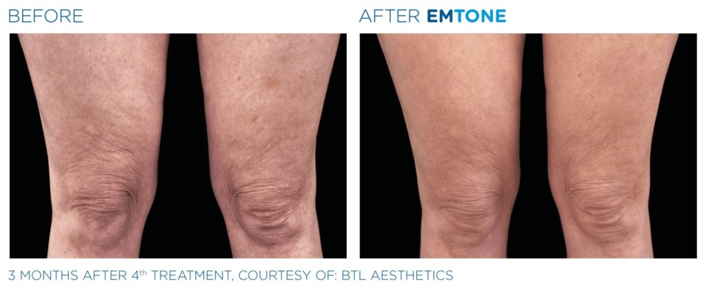 Emtone réduction significative des amas graisseux à l’origine de la cellulite