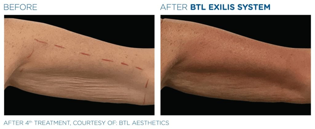 Traitement Exilis Ultra 360 pour l'amélioration du relâchement cutanée