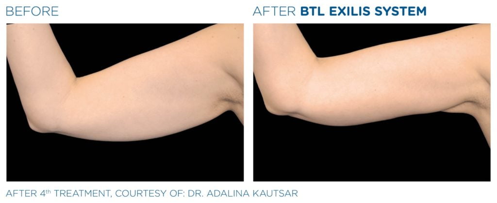 Traitement Exilis Ultra 360 pour le raffermissement de la peau