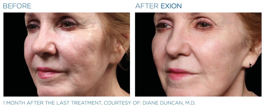 Améliorez votre peau avec le microneedling EXION au Luxembourg