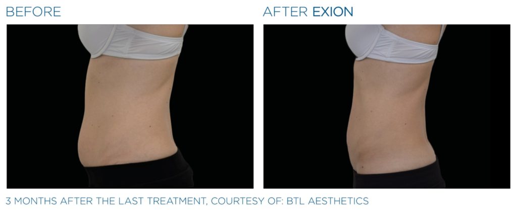 Solutions pour le visage et le corps EXION au Luxembourg