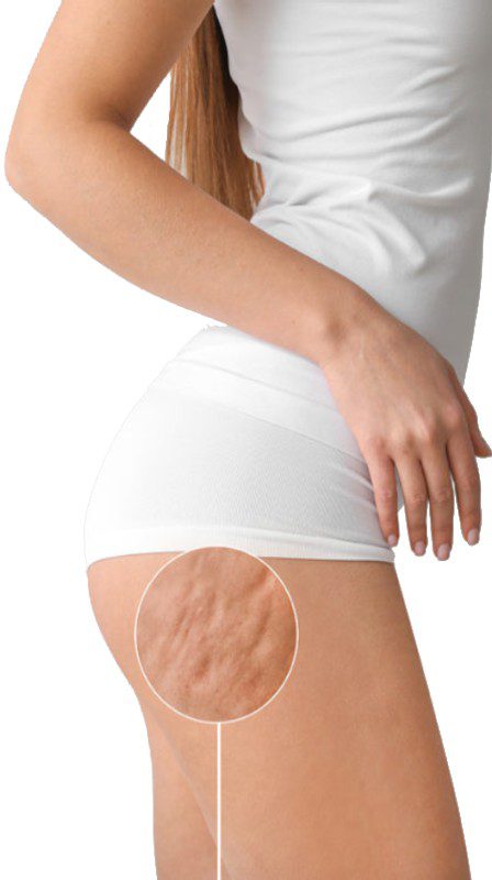 Les Solutions pour éliminer la cellulite